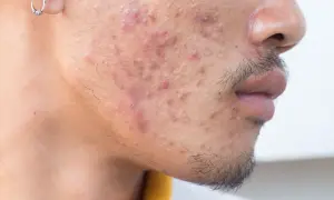 Visage d'un homme avec de l'acné. Une solution à base de rétinoïdes médicament pourrait aider à traiter ces imperfections.