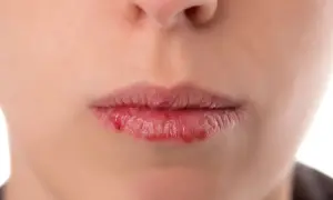 Popękane, suche usta z zaczerwienieniem. Szukasz domowych sposobów na suchość w ustach?