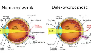 Na czym polega dalekowzroczność? Obraz pokazuje, że światło skupia się za siatkówką, a nie na niej, co powoduje nieostre widzenie.