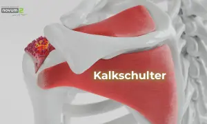 Kalkschulter: Ablagerungen im Schultergelenk. Was tun? Hier sehen Sie die Darstellung einer schmerzhaften Kalkschulter.