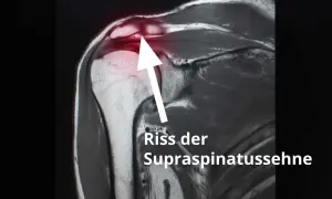MRT-Aufnahme zeigt Riss der Supraspinatussehne. Erfahrungen mit Schulter-OP nach Sehnenriss.