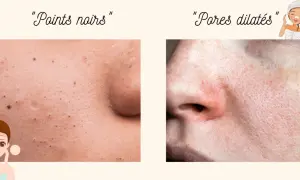 Comparaison de peau : points noirs et pores dilatés. Découvrez comment resserrer les pores pour une peau plus lisse.