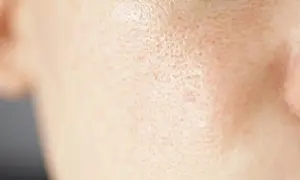 Primo piano della pelle del viso con pori dilatati sulle guance, evidenziando la texture.