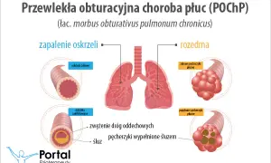 POChP a klimat: Gdzie szukać ulgi i jak oddychać lepiej?