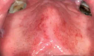 Palato con aree arrossate e puntini rossi, indicativi di una lesione palato. Si notano anche denti e gengive.