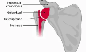 Anatomische Darstellung des Schultergelenks mit Humerus, Gelenkkopf, Gelenkpfanne, Acromion und Processus coracoideus. Eine inverse Schulterprothese ersetzt diese Strukturen.