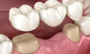 Nowe zęby, w tym most ceramiczny, gotowe do zamocowania.