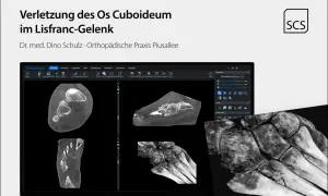 CT-Aufnahmen zeigen eine Verletzung des Os cuboideum im Lisfranc-Gelenk. Die Darstellung ermöglicht eine detaillierte Analyse der Knochenstruktur.