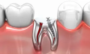 Wkład korzeniowo koronowy w zębie, pokazujący kanały korzeniowe i narzędzie dentystyczne.