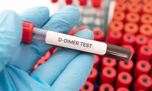 Ręka w niebieskiej rękawiczce trzyma probówkę z krwią do badania D-dimery. Co to za badanie? To test oceniający krzepliwość krwi.