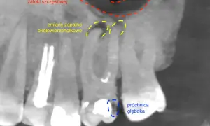 Obraz RTG z widocznymi zmianami zapalnymi okołowierzchołkowymi zęba, zapaleniem zatoki szczękowej i głęboką próchnicą.