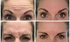 Vier close-ups van een voorhoofd met rimpels, die de effecten van botox tonen. Sommigen beweren dat botox slecht voor hersenen kan zijn.