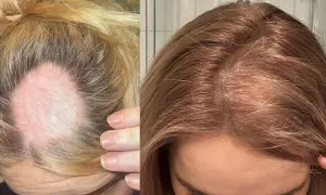 Före- och efterbilder visar tydligt hur håravfall stress kan påverka hårbotten. Till vänster syns en kal fläck, till höger ett tjockare hår.