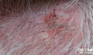 Gros plan sur un cuir chevelu sec et irrité, avec des squames et des rougeurs, suggérant une perte de cheveux.