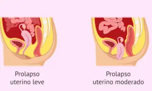 Ilustración comparativa de prolapso uterino leve y moderado, mostrando la posición del útero y órganos pélvicos.
