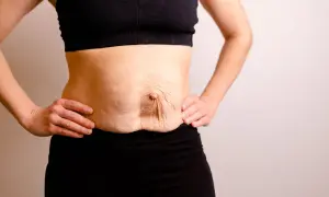 Addome con diastasi addominale di 4 cm, pelle rilassata e smagliature.