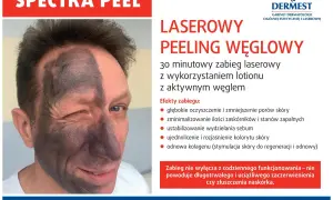 Laserowy peeling węglowy przed i po: połowa twarzy pokryta czarną maską węglową, druga połowa czysta. Efekty zabiegu widoczne.