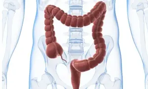 En illustration av tjocktarmen, med dess segmenterade utseende. Kan vara relevant vid undersökning av psoas tecken.