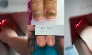 Grzybica paznokci: Od lakieru po laser co wyleczy ją na stałe?