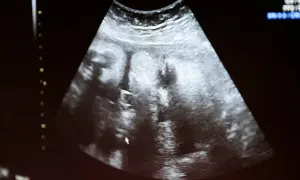 Ultraljudsbild som visar tecken på missed abortion.