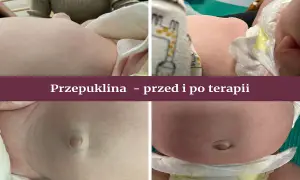 Objawy przepukliny pępkowej: Jak rozpoznać i kiedy działać?