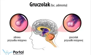 Gruczolak przysadki: objawy psychiczne. Czy to hormony?