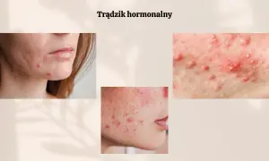 Badania hormonalne na trądzik: Ceny, NFZ i droga do zdrowej cery