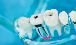 Model szczęki z widoczną próchnicą przy dziąśle. Ciemne ubytki w zębach, widoczne korzenie.