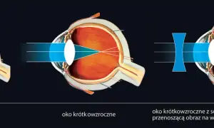Krótkowzroczność: Jakie soczewki wybrać? Poradnik dla Ciebie