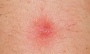 Czerwona, zapalna krostka na skórze, która może wymagać leczenia detreomycyną.