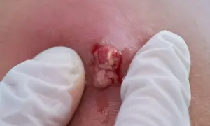 Nahaufnahme eines Abszesses in der Leiste, der von weißen Handschuhen gehalten wird. Eiter und Blut sind sichtbar.
