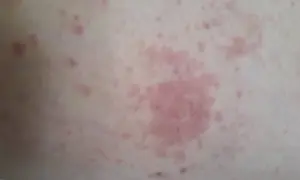Éruption cutanée rosée sur la peau, possiblement liée à un staphylocoque doré combien de temps après opération.