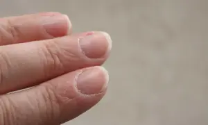 Zbliżenie na palce z widocznymi zadziorami przy paznokciach i suchą skórą.