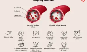 Ilustracja pokazuje objawy anemii u dziecka: bladość skóry, spadek energii, bóle głowy, zmęczenie, zaburzenia koncentracji i pamięci.