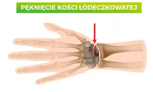 Ilustracja anatomiczna dłoni z zaznaczonym pęknięciem kości łódeczkowatej.