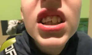 Złamany ząb przy dziąśle, widoczny na zbliżeniu ust.