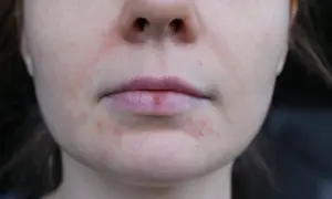 Skóra wokół ust z zaczerwienieniami i wypryskami, sugerującymi zapalenie okołoustne.
