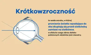 Krótkowzroczność: Objawy, przyczyny i skuteczne metody korekcji