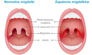 Trzeci migdał u dziecka: Obkurcz go bez operacji? Kiedy działać.