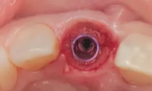 Implant stomatologiczny w zębodole. Czas oczekiwania po wyrwaniu zęba na wstawienie protezy zależy od wielu czynników.