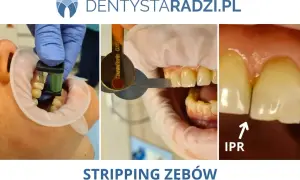 Ortodonta wykonuje stripping zębów, czyli delikatne ścieranie szkliwa, aby stworzyć przestrzeń.