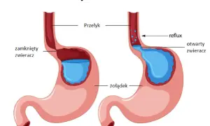 Ilustracja pokazuje, co to refluks żołądkowo-przełykowy: cofanie się treści żołądkowej do przełyku z powodu otwartego zwieracza.