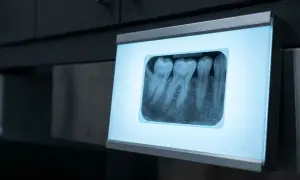 Rentgen zębów pokazuje, że próchnica zatrzymana. Zdrowe korzenie i korony zębów.