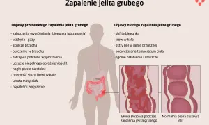 Ilustracja przedstawia objawy zapalenia jelita grubego: przewlekłe (zaburzenia wypróżniania, wzdęcia, skurcze) i ostre (biegunka, krew w kale, ból brzucha). Pokazuje też wygląd błony śluzowej jelita.