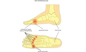 Illustrazione anatomica del piede che mostra la metatarsalgia. Evidenziate le aree di dolorabilità nelle teste metatarsali e le ossa sesamoidi, con riferimento al tarso e metatarso.