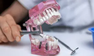 Model szczęki z implantami i mostem tymczasowym. Dowiedz się, jak długo można nosić most tymczasowy.
