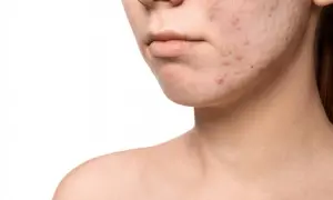 Primo piano di un volto con pelle congestionata e acne. Imperfezioni visibili sul mento e sulla guancia.