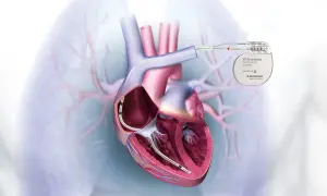 Cœur humain avec un défibrillateur cardiaque implanté, relié à un appareil externe.