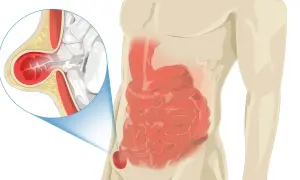 Ilustracja przedstawia przepuklinę pachwinową u kobiety w ciąży. Powiększony fragment pokazuje uwypuklenie jelita przez osłabiony mięsień.