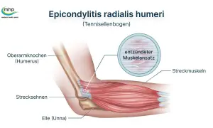 Illustration zeigt den Tennisellenbogen (Epicondylitis radialis humeri) mit entzündetem Muskelansatz. Darf man mit Tennisarm arbeiten? Ja, oft mit Anpassungen.